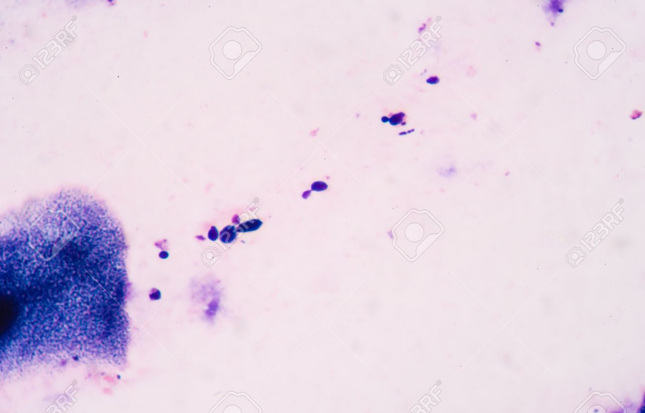 budding yeast cells with pseudohyphae from sputum gram stain test in laboratoryfine with
