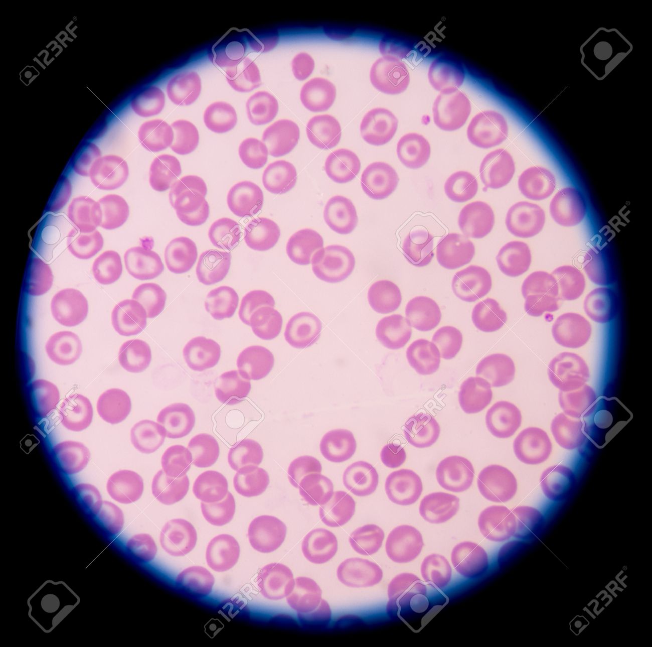 rbc morphology abnormal