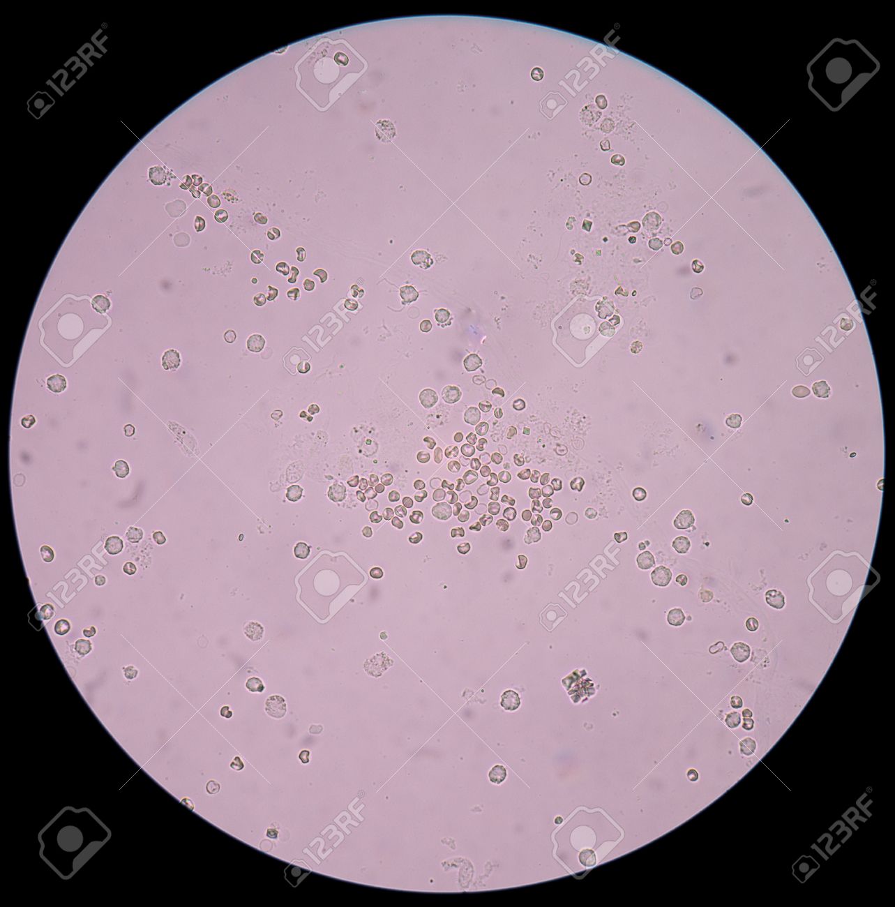 Des Cellules Fraiches Rouges Du Sang Les Globules Blancs L Oxalate De Calcium Dans L Urine Examen Banque D Images Et Photos Libres De Droits Image 47437139
