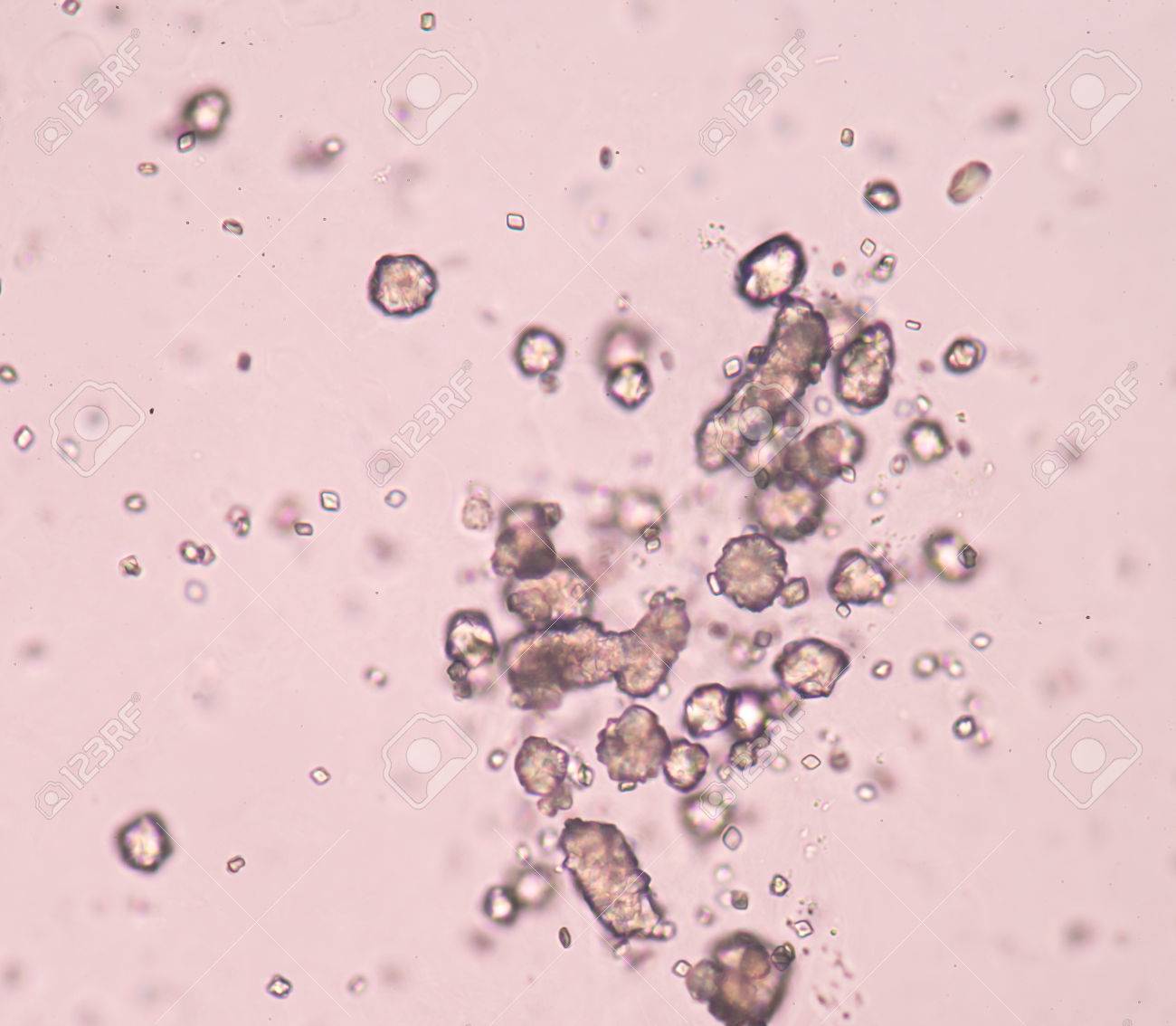 Microscopic image showing calcium oxalate monohydrate, uric acid crystals  and triple phosphate crystals from urine sediment. UTI. kidney disease.  12601160 Stock Photo at Vecteezy, image size:1300x1134