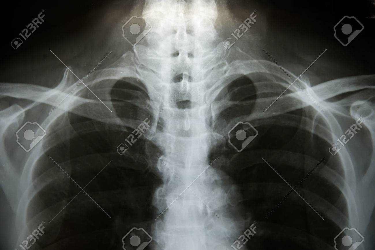X-Ray Image Of Human Chest for a medical diagnosis. - 57740833 X-Ray Image Of Human Chest for a medical diagnosis. - 57740833