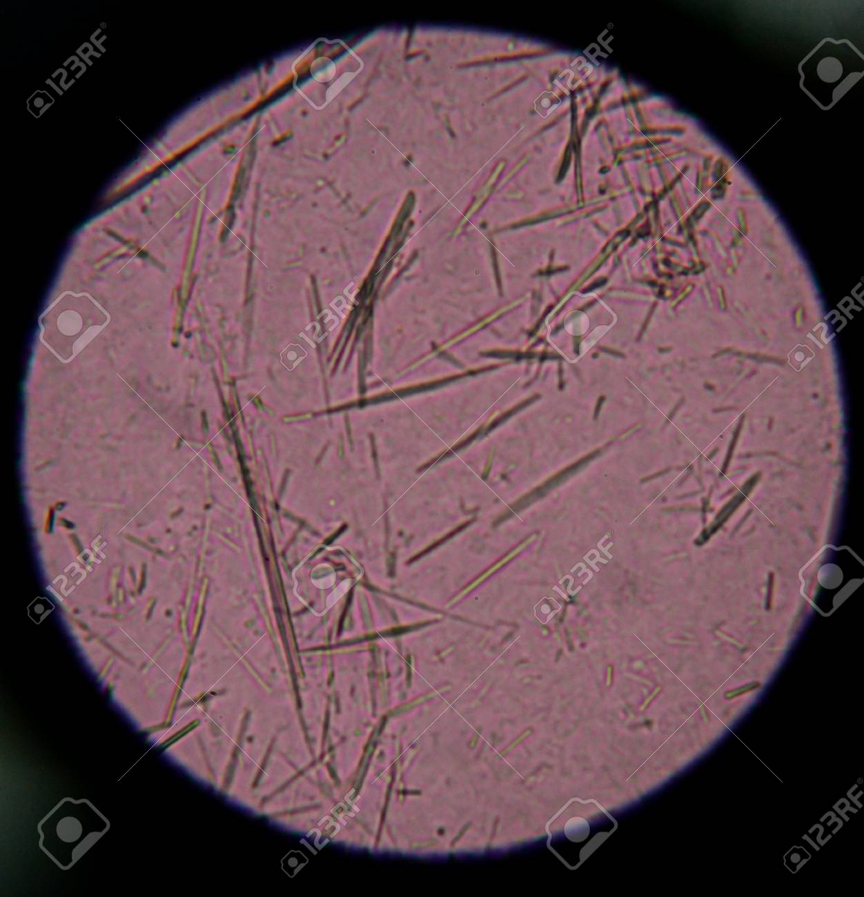 滑液の緩やかな尿酸結晶針状形状を顕微鏡で見つけます の写真素材 画像素材 Image