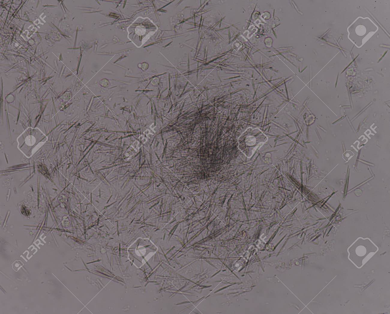 Moderate Uric Acid Crystal Needle Shape In Synovial Fluid Find With  Microscope. Stock Photo, Picture and Royalty Free Image. Image 86799091., image size:1300x1045