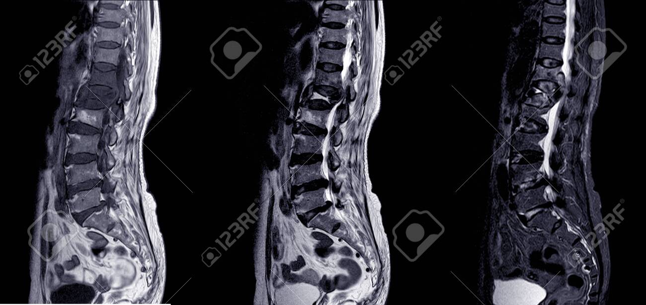MRI OF THE LUMBOSACRAL SPINE.A 69-year-old female with low back pain for 3 months, to rule out HNP or TB spine. - 132331282 MRI OF THE LUMBOSACRAL SPINE.A 69-year-old female with low back pain for 3 months, to rule out HNP or TB spine. - 132331282