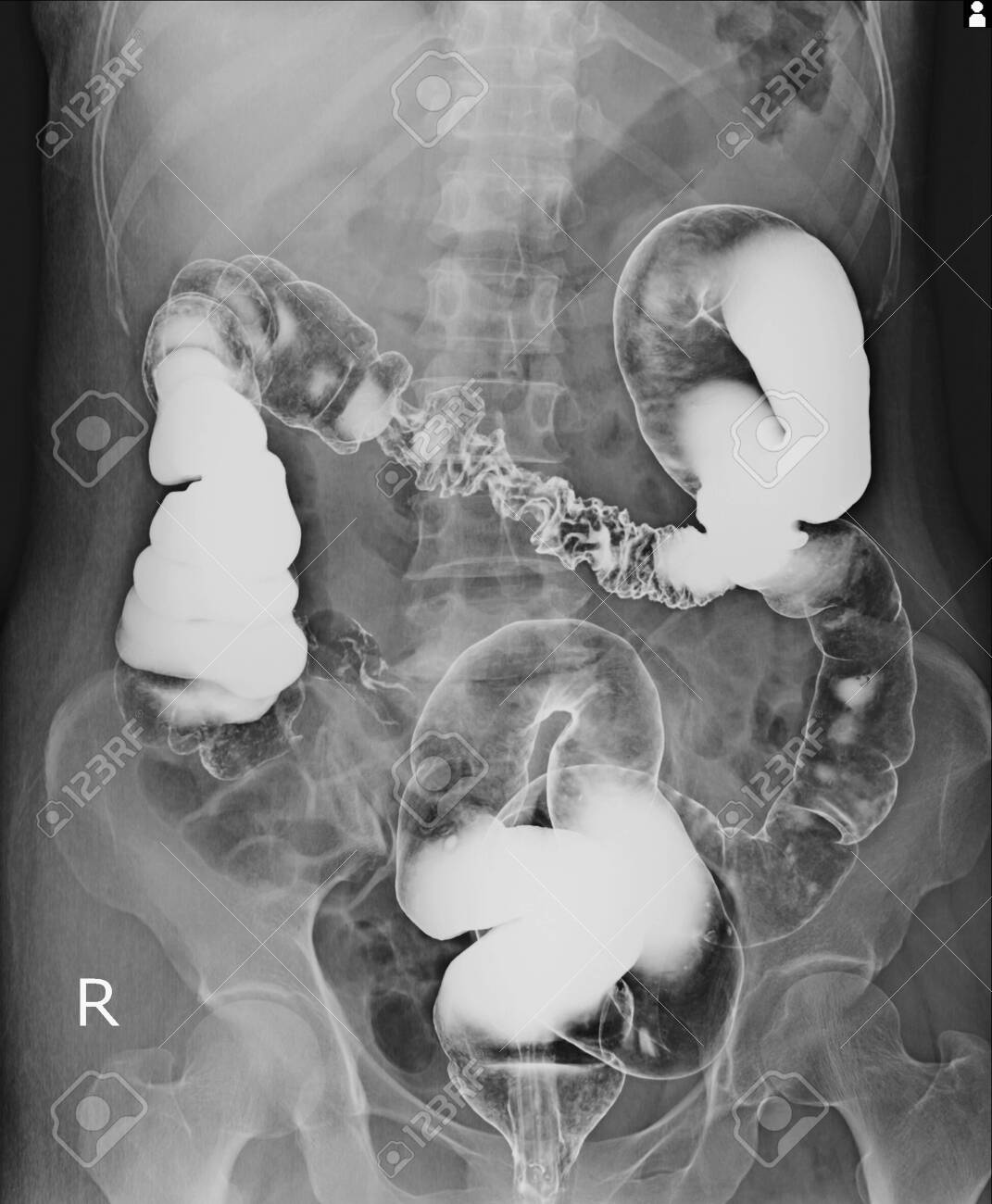 рентген поясницы подготовка. шейный отдел позвоночника новорожденного на рентгене. поясничный отдел позвоночника рентген анатомия. люмбализация s1 позвонка рентген. функциональные рентгенограммы поясничного отдела позвоночника.