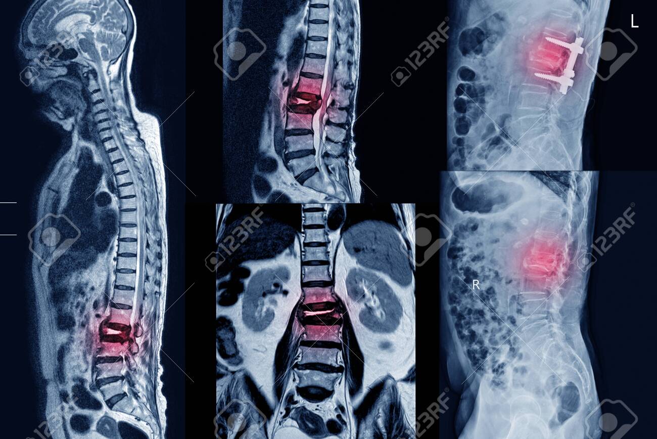 Collection MRI Of Lumbar Spine History Of Fall With Back Pain