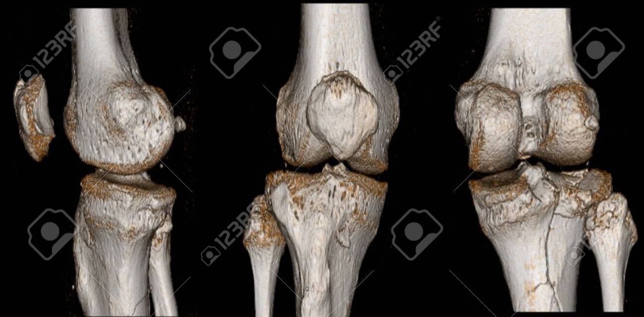 Ct Scan Knee Fracture Of Intercondylar Eminence Of Tibia Compression Stock Photo Picture And Royalty Free Image Image 150961547