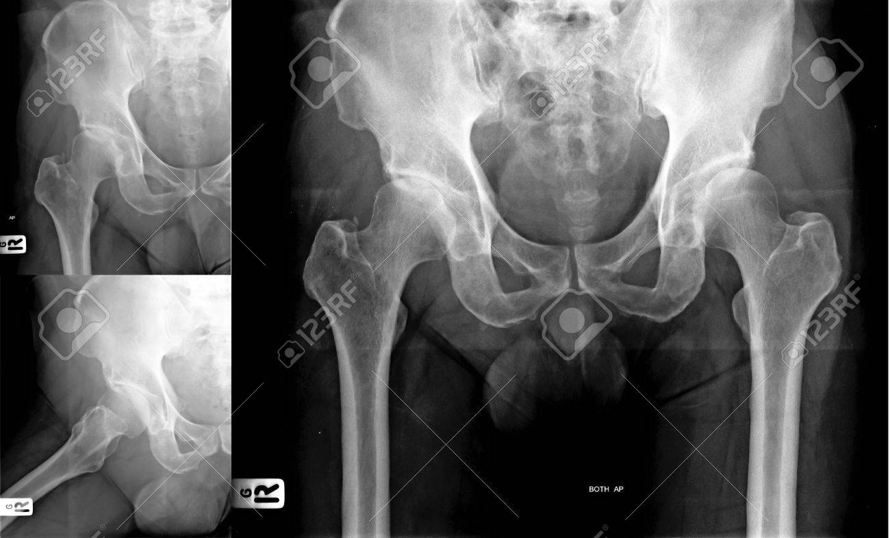 cadera osteoartritis radiografoa