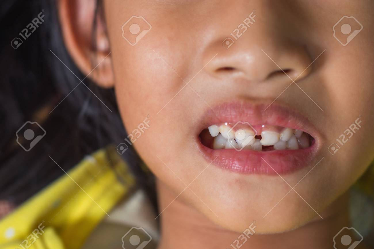 患者開口表示虫歯を子供します の写真素材 画像素材 Image