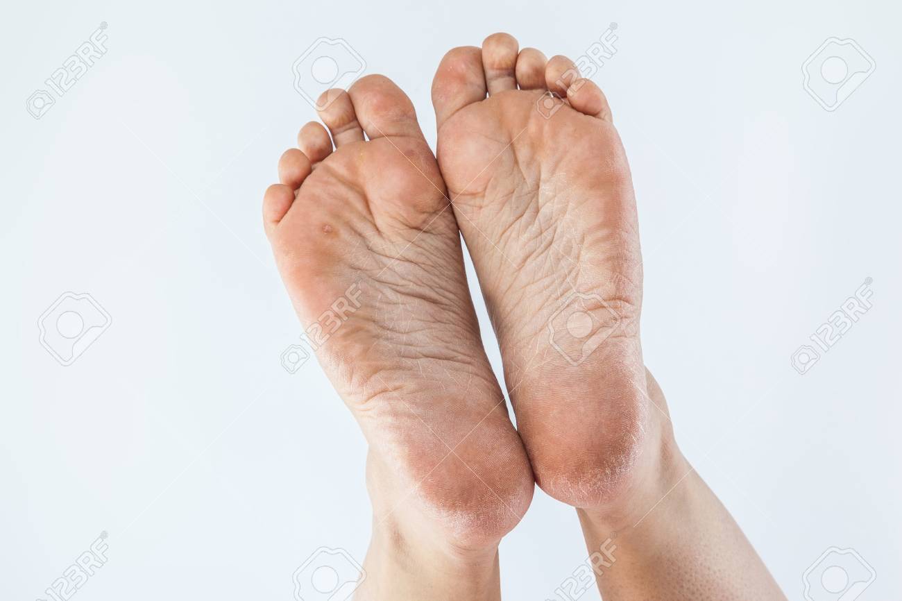 Dry callused feet