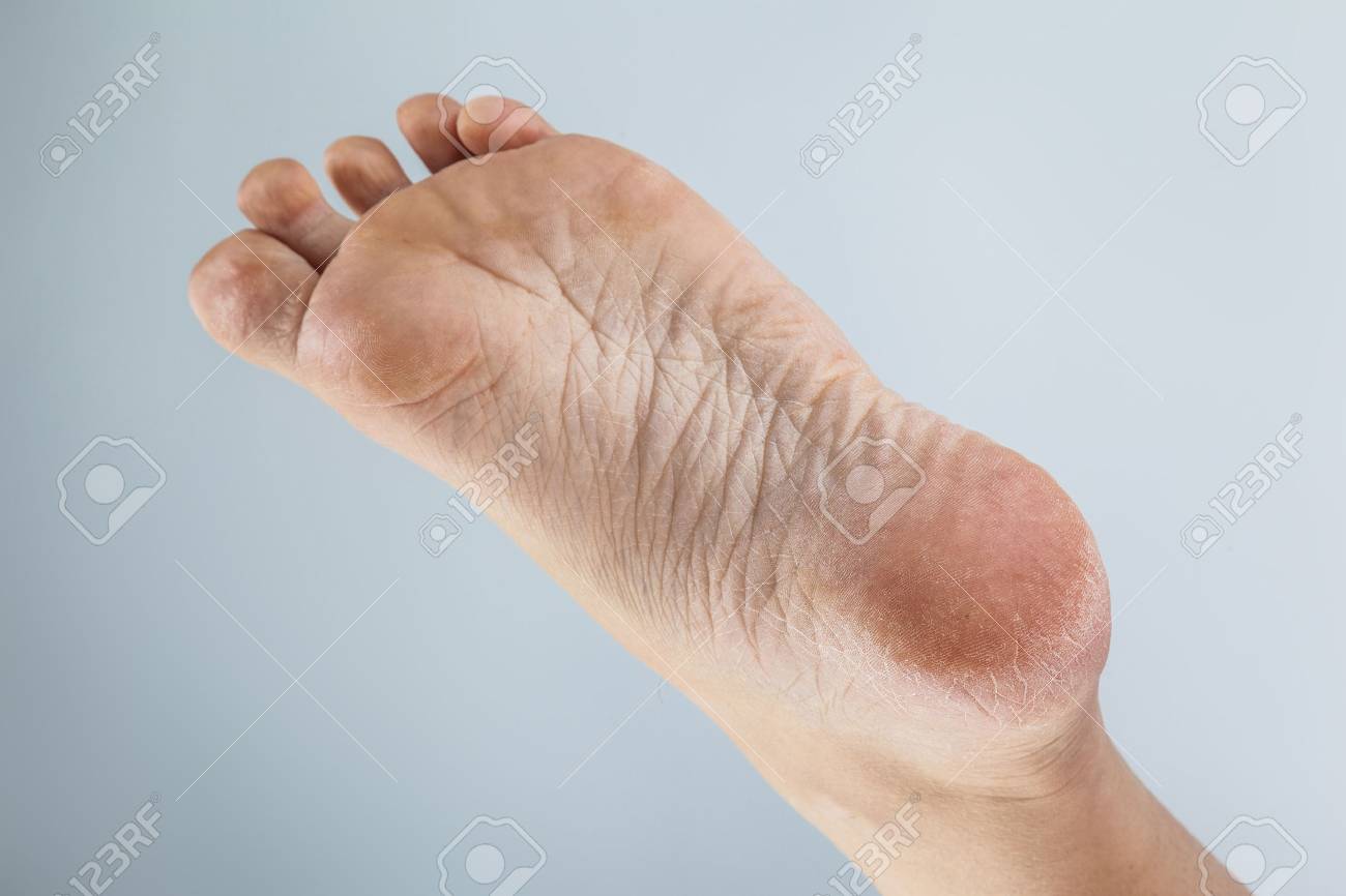 足やかかとで乾燥した肌を手入れ 割れたトウモロコシ の写真素材 画像素材 Image