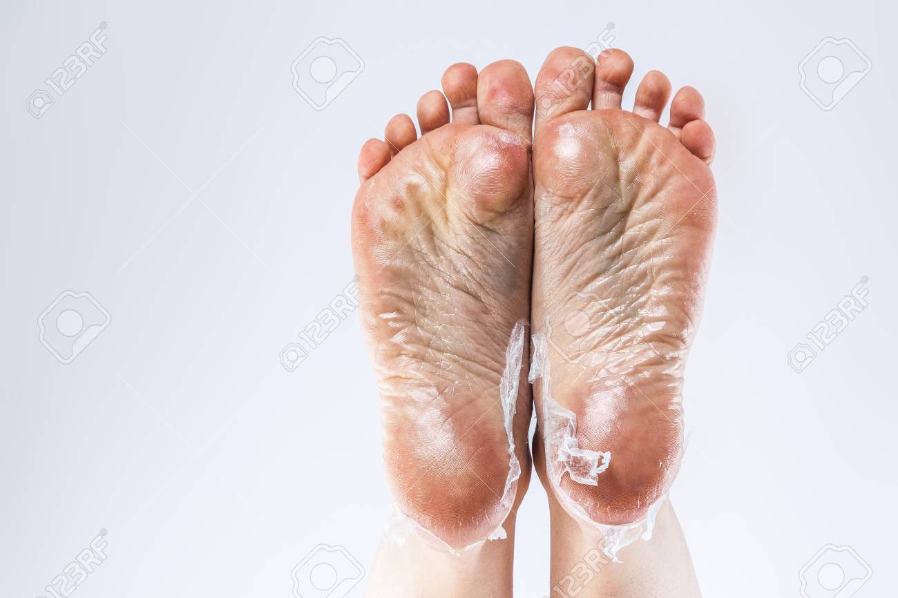 peau seche pied