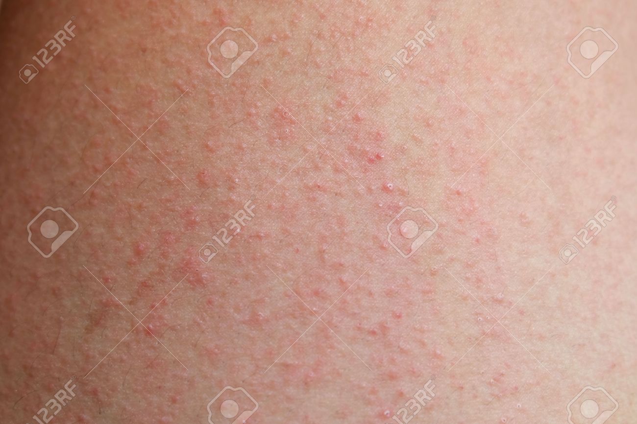 erupción dermatitis alérgica de la piel del paciente fotos retratos