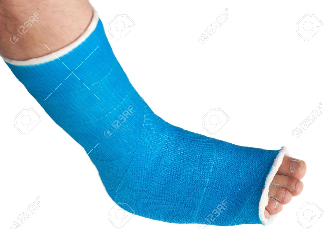 Broken Leg In A Plaster Cast Isolated On White Stock Photo, Picture and  Royalty Free Image. Image 14882313., image size:1300x893