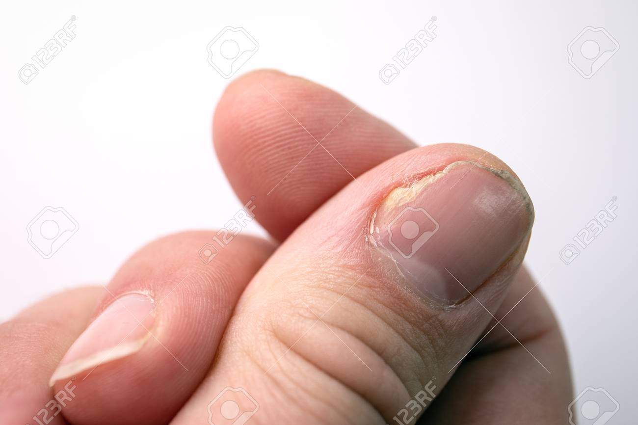 finger fungus treatment