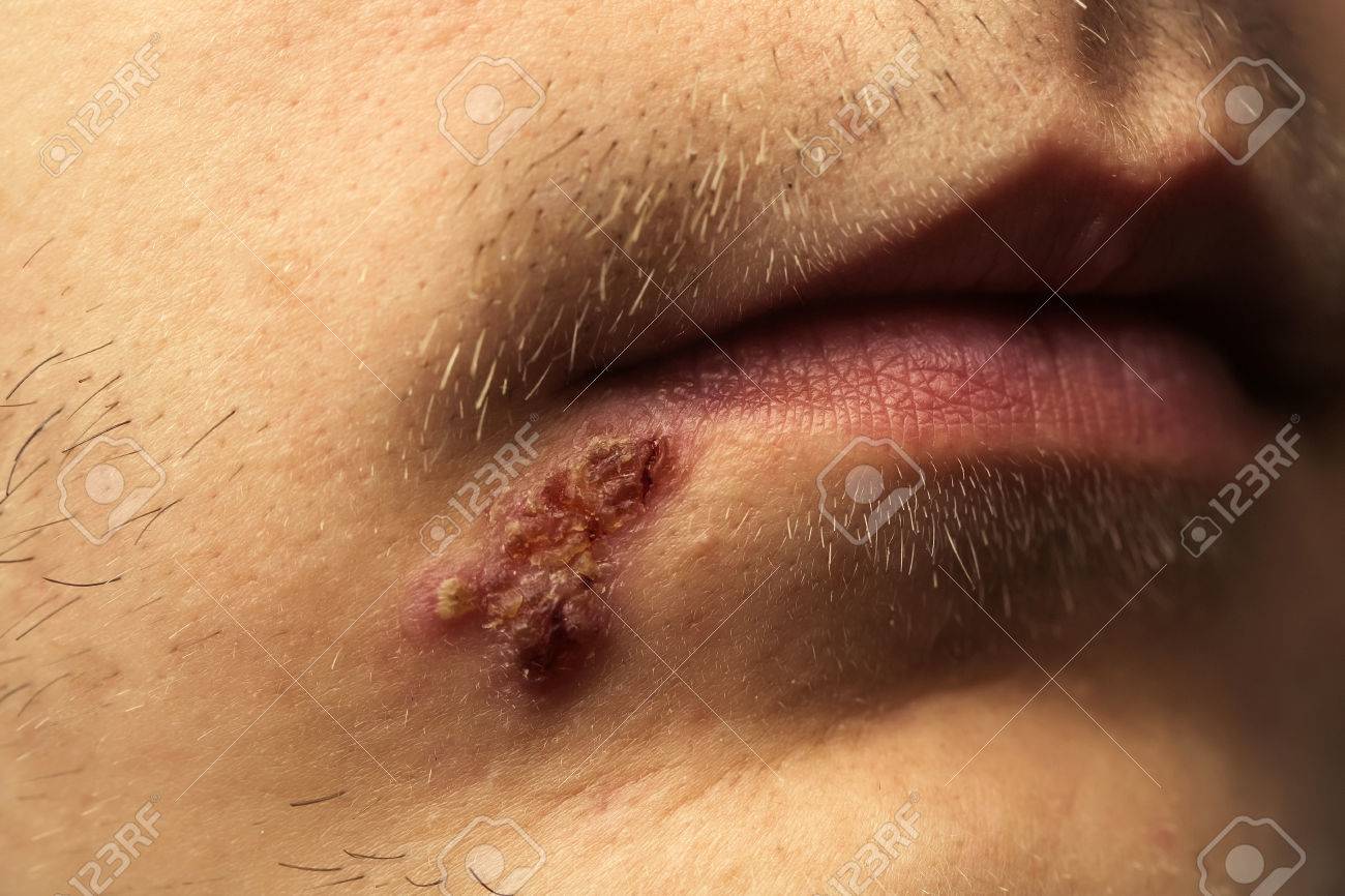 Seca ulcera