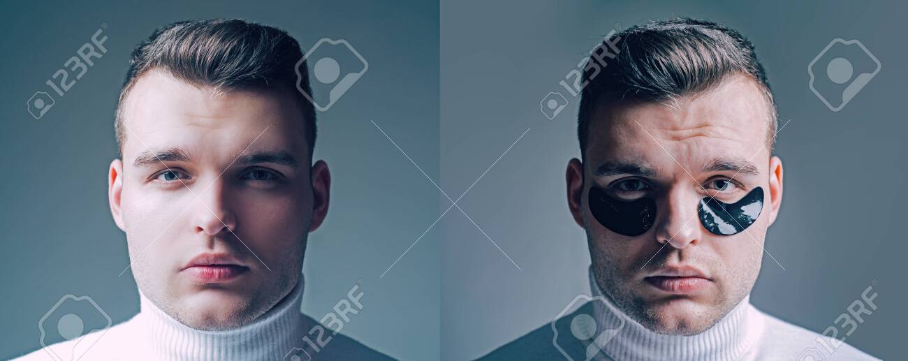 dark eye circles men