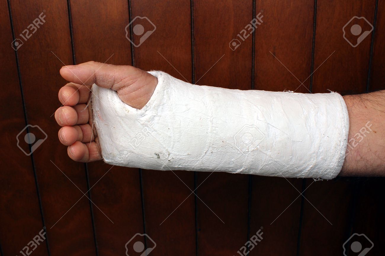 Меняют ли гипс. Меняют ли гипс. Меняют ли гипс. Перелом пястной кости гипс. Турбокаст на коленный сустав.