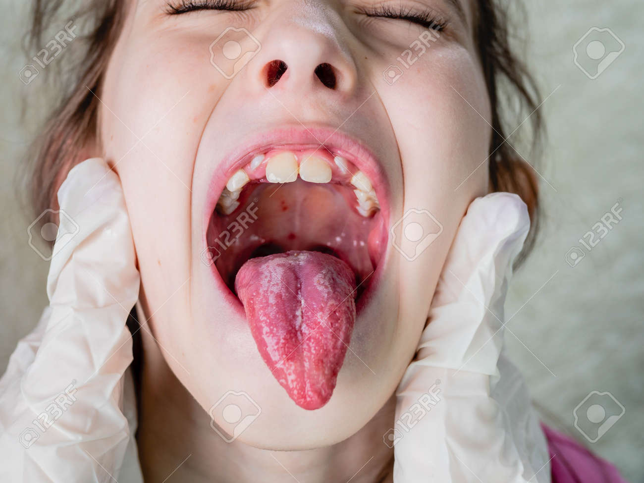 The Doctor Checks The Sore Throat Of A Little Girl. Small Ulcers On The  Palate And Throat In A Child Stock Photo, Picture and Royalty Free Image.  Image 165923396., image size:1300x975