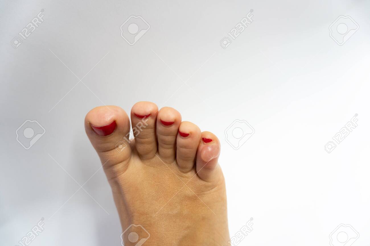 white corn on toe