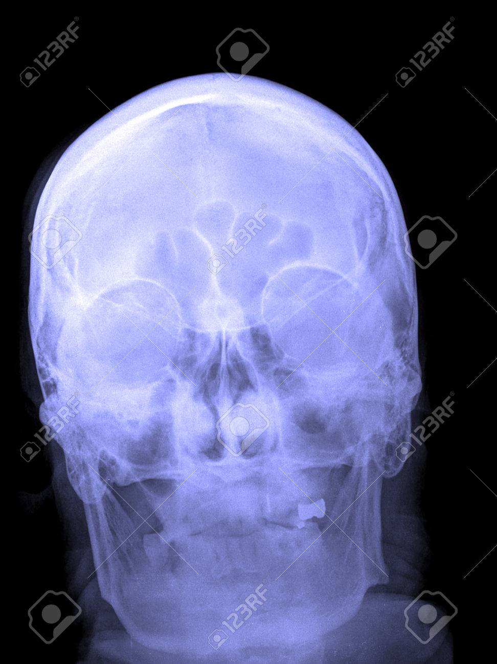 頭蓋骨の X 線写真 医療診断用頭部 X 線フィルムの詳細です の写真素材 画像素材 Image