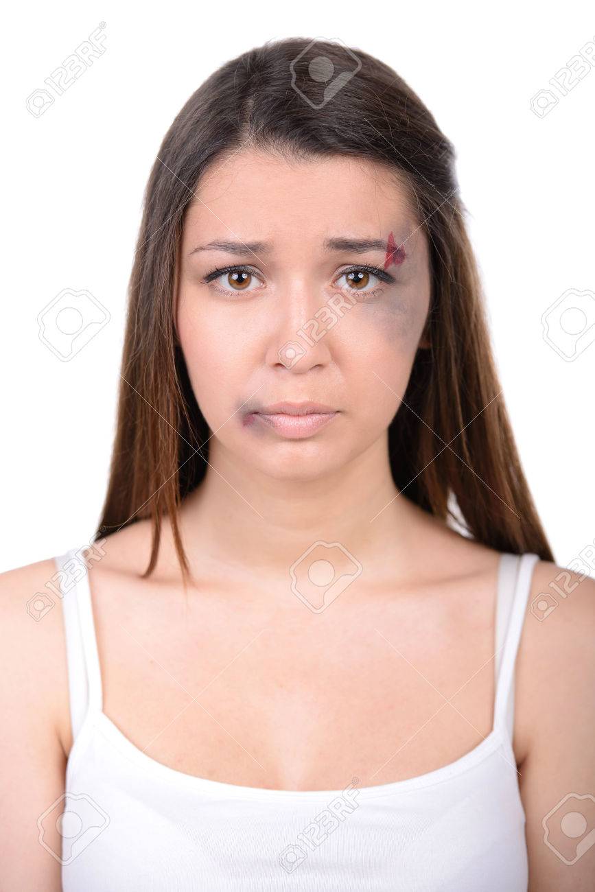 彼女の顔にあざと思いやりのある女性の肖像画 離れて悲しい表情で見てください の写真素材 画像素材 Image