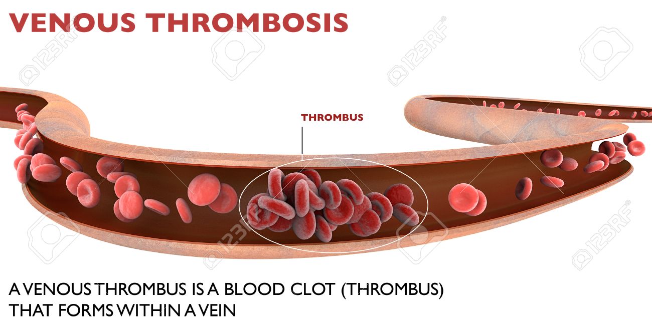 Deep Vein Thrombosis A Blood Clot Within At Vein Stock Photo Picture And Royalty Free Image Image 59148139