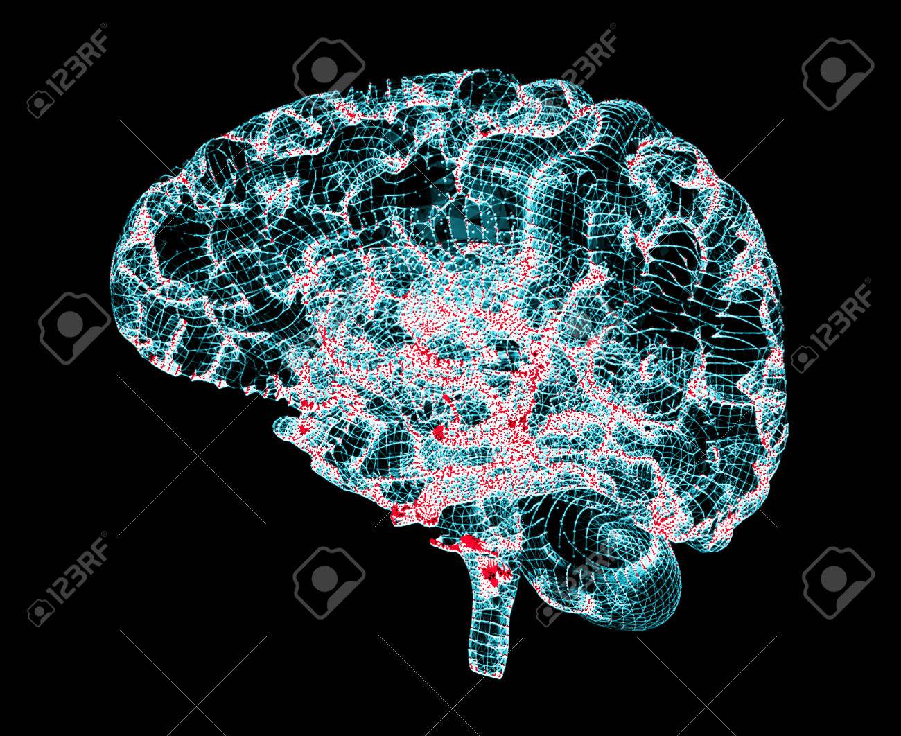 脳の変性疾患 パーキンソン病 アルツハイマー病の 3 D レンダリング の写真素材 画像素材 Image