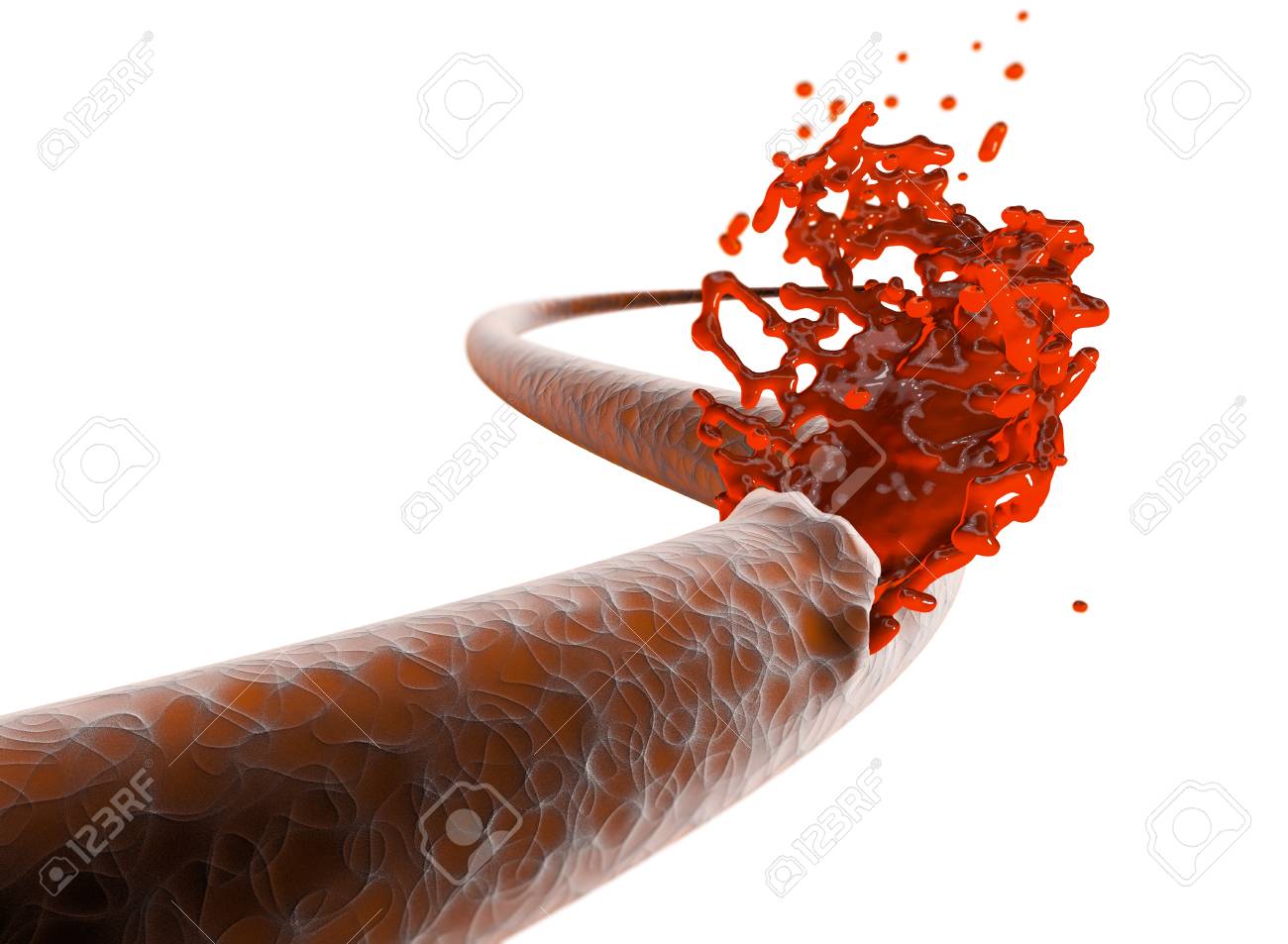 Vein, artery, rupture cut blood hemorrhage. Internal bleeding, cut of a vein and exit of blood - 98596711 Vein, artery, rupture cut blood hemorrhage. Internal bleeding, cut of a vein and exit of blood - 98596711