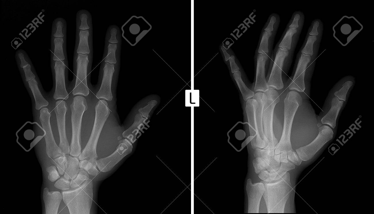 手の X 線写真 左手の小指の末節骨の亜脱臼を示しています の写真素材 画像素材 Image
