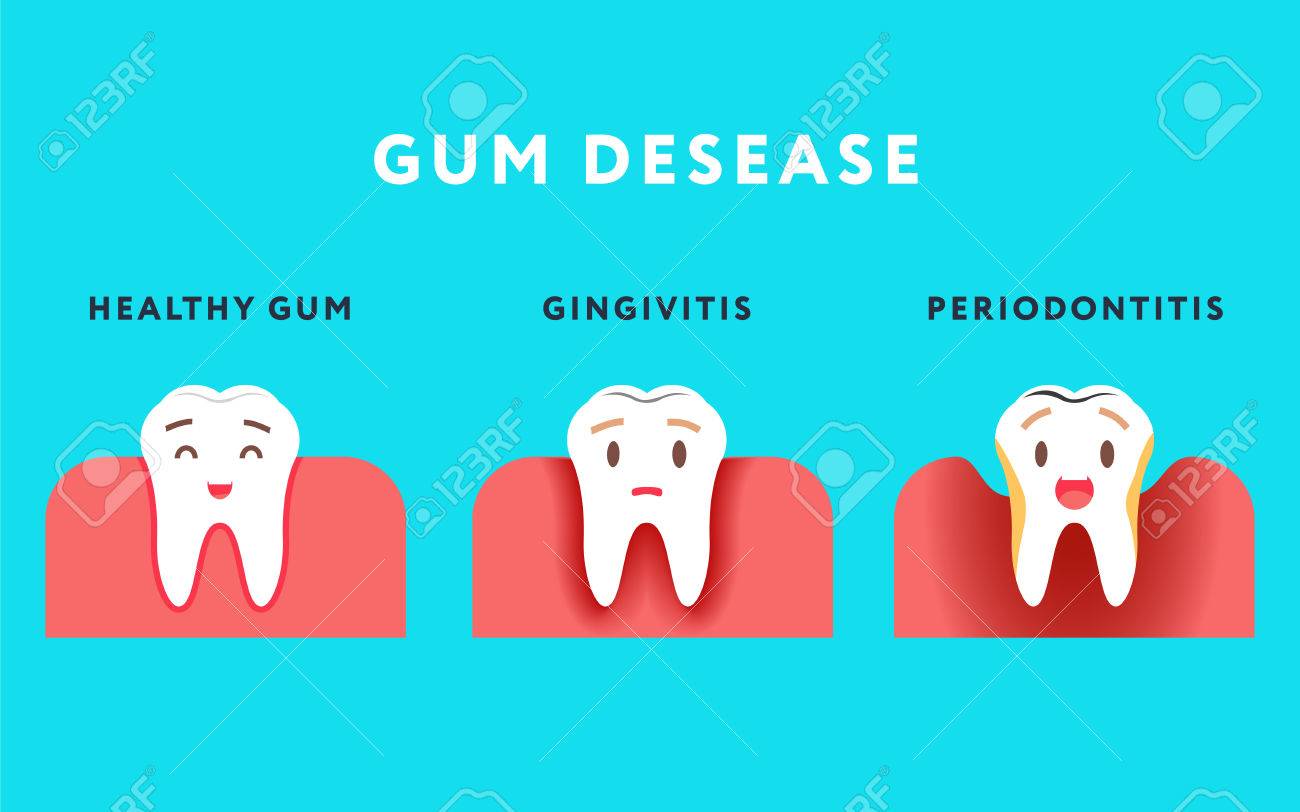 歯周病のステップ 健康な歯と歯肉炎 かわいい漫画のデザイン イラストの青い背景に分離されました のイラスト素材 ベクタ Image