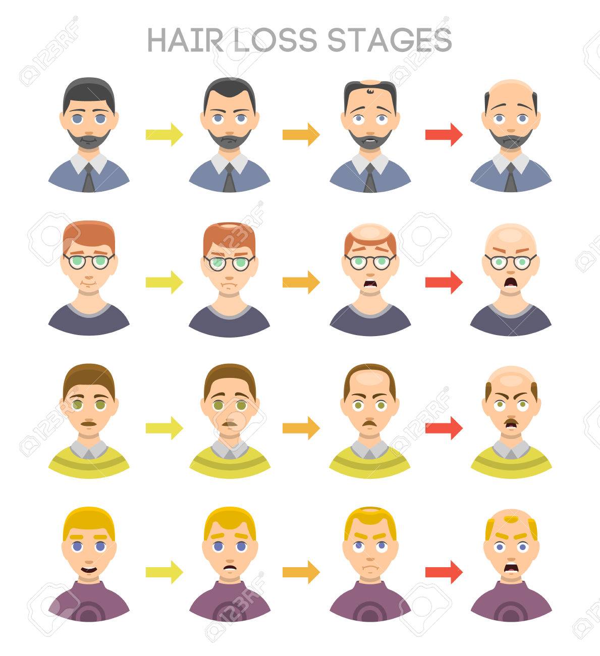 Information Chart Of Hair Loss Stages And Types Of Baldness