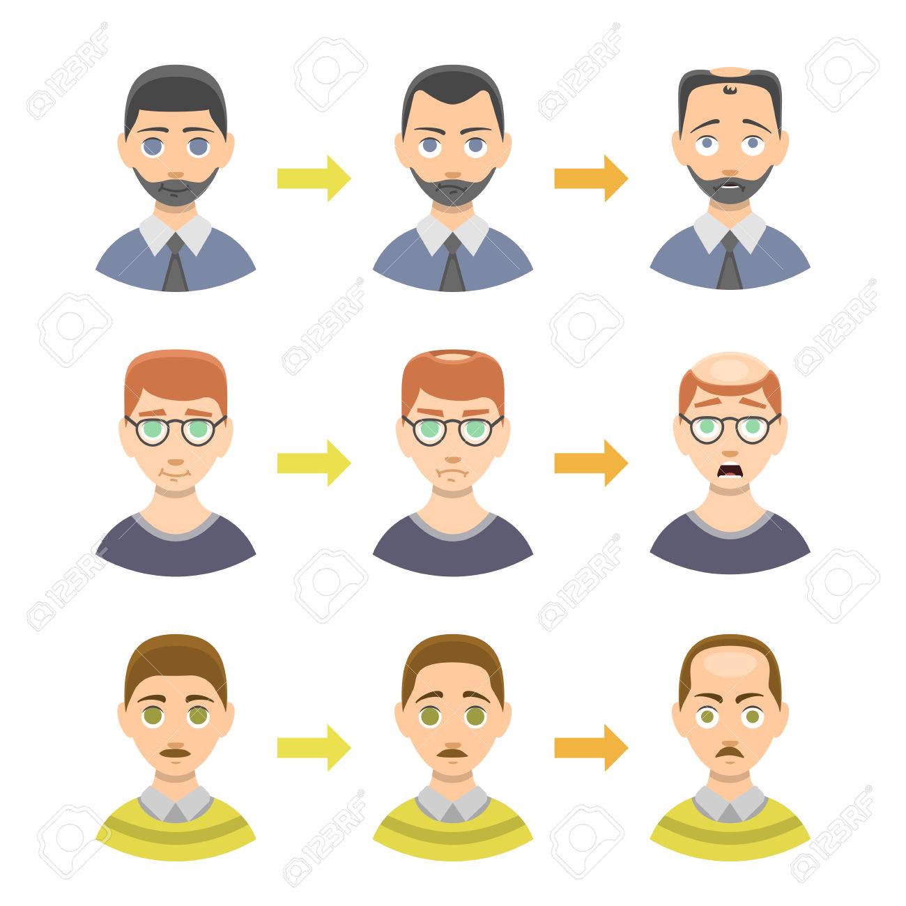 Information Chart Of Hair Loss Stages Types Of Baldness