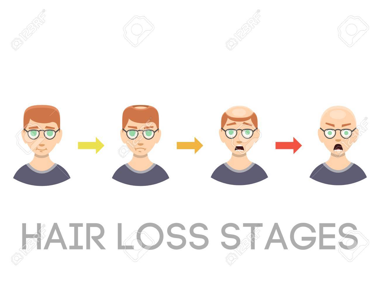 Information Chart Of Hair Loss Stages Types Of Baldness