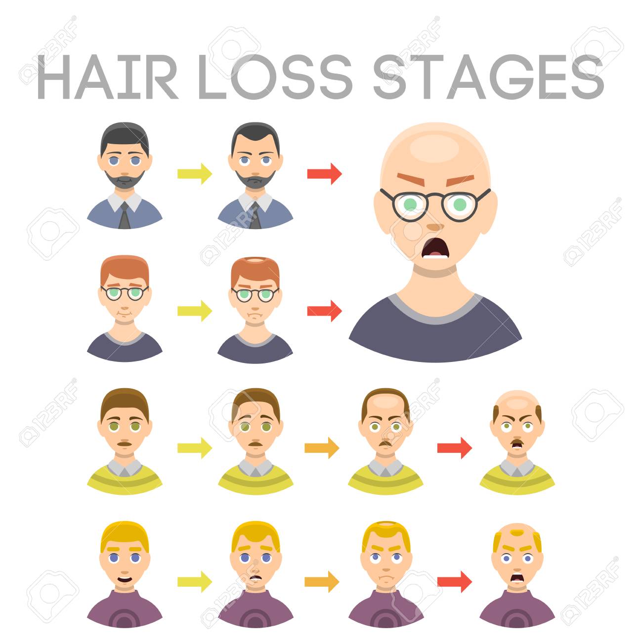 Information Chart Of Hair Loss Stages Types Of Baldness