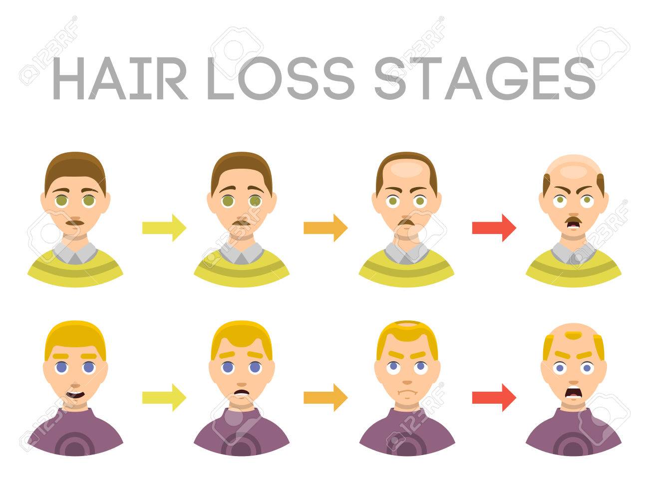 Information Chart Of Hair Loss Stages Types Of Baldness