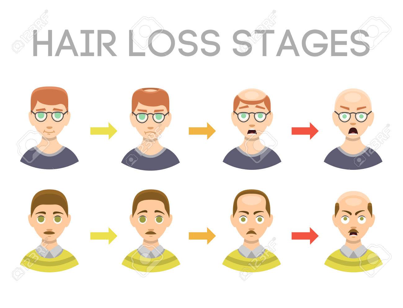 Information Chart Of Hair Loss Stages Types Of Baldness