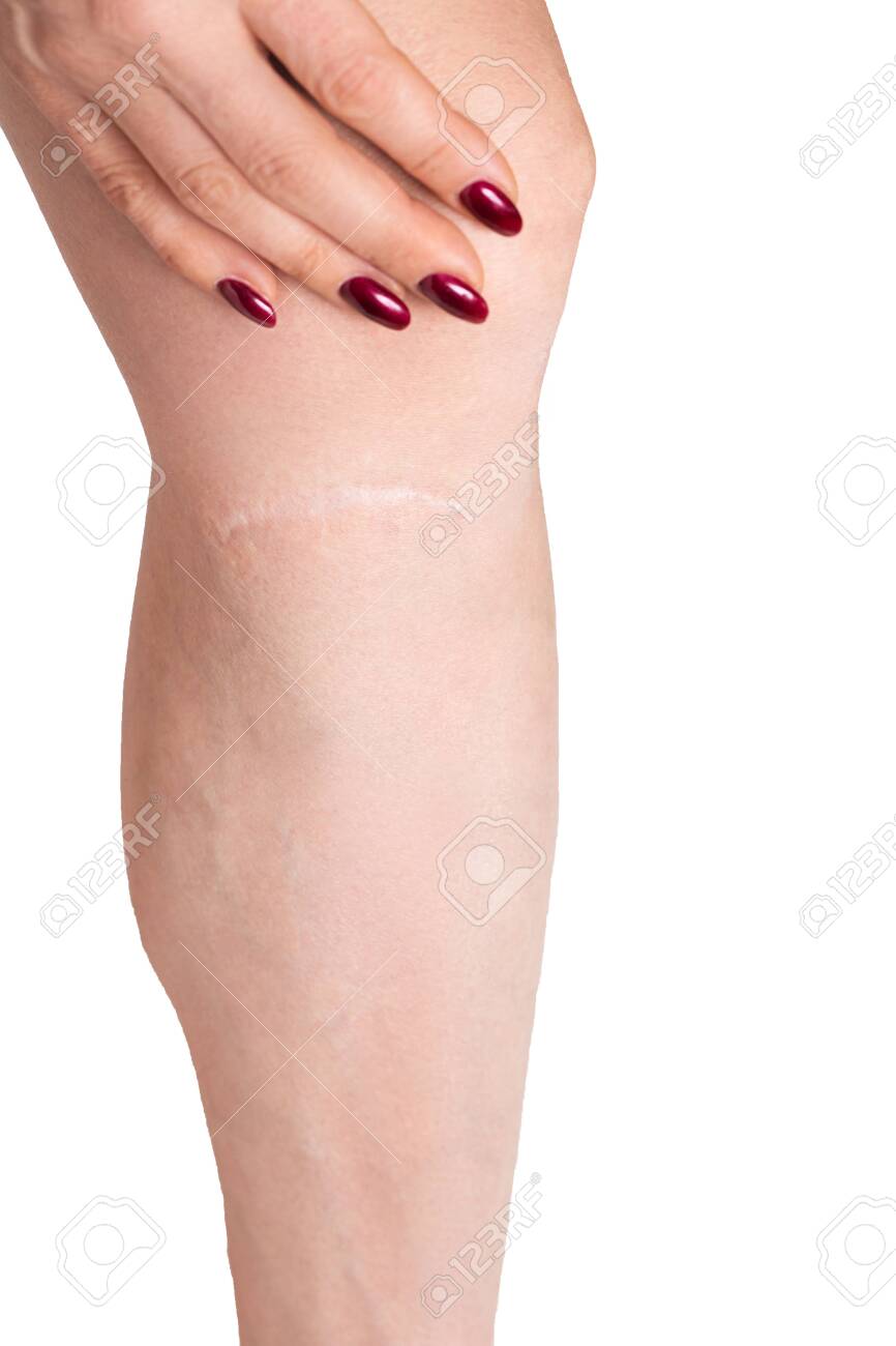 Stock foto varicose nail recenzii Clinici pentru chirurgia varicelor Varicose hands photo