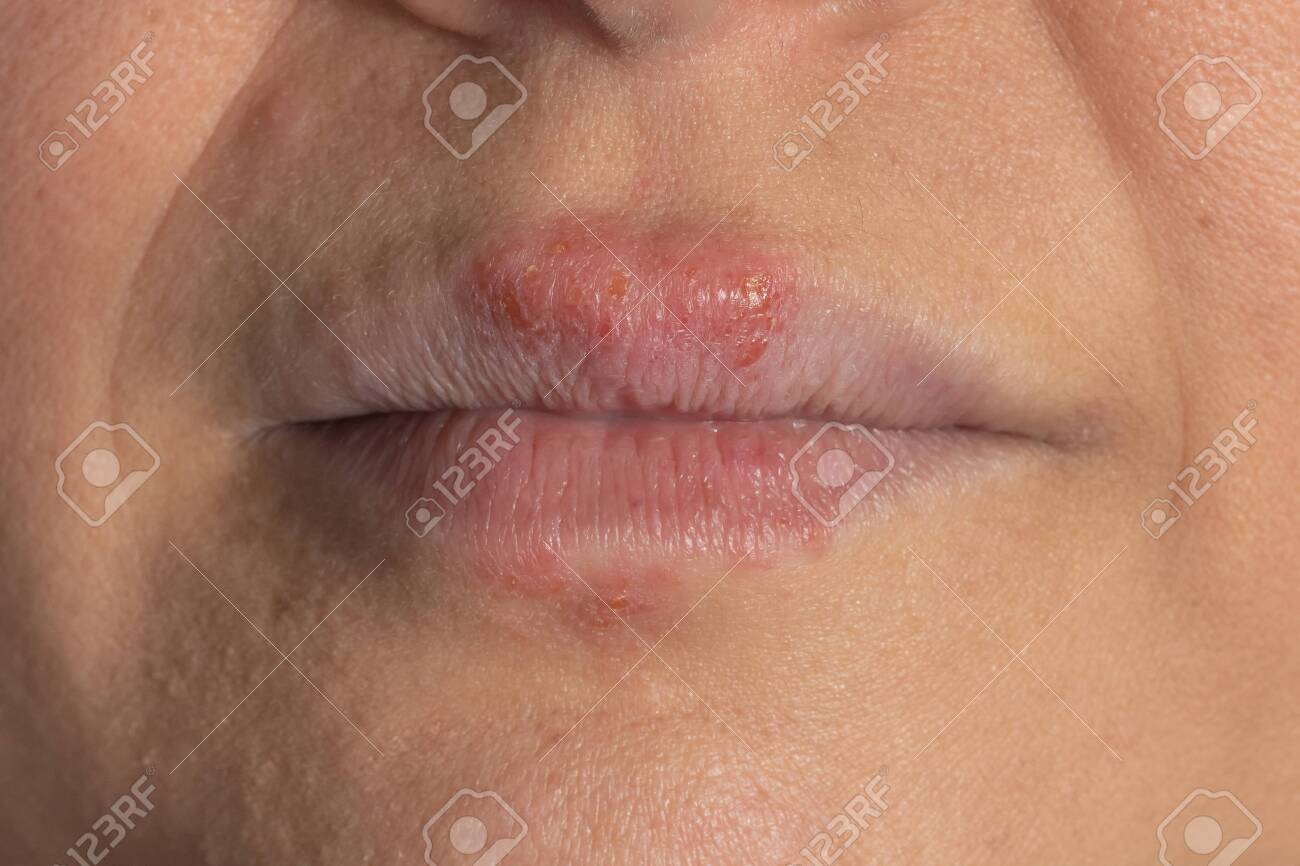 Allergic Reaction To Metal On The Lips Of A Middle Aged White Woman Stock Photo Picture And Royalty Free Image Image 143072982