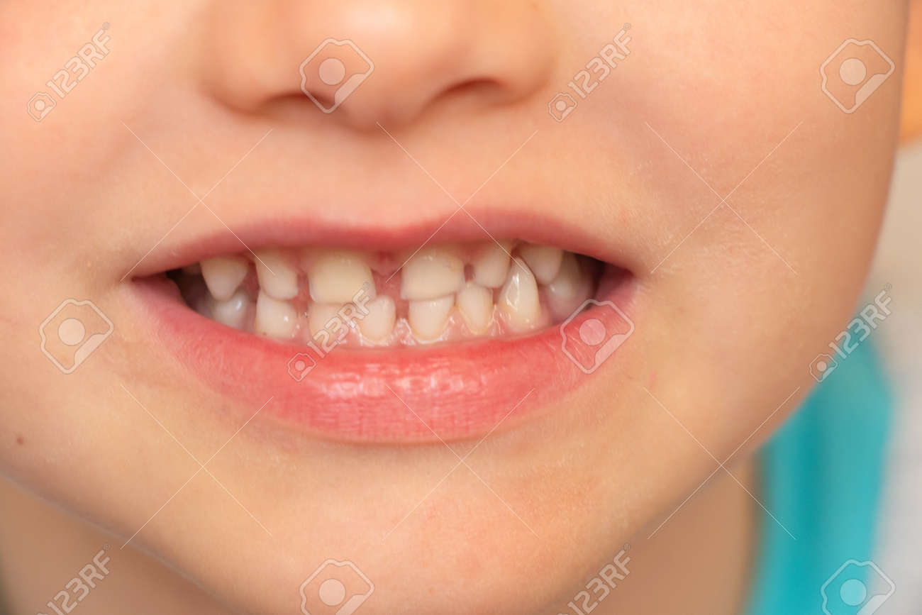 baby white teeth close-up, smiling little boy - 148063670 baby white teeth close-up, smiling little boy - 148063670