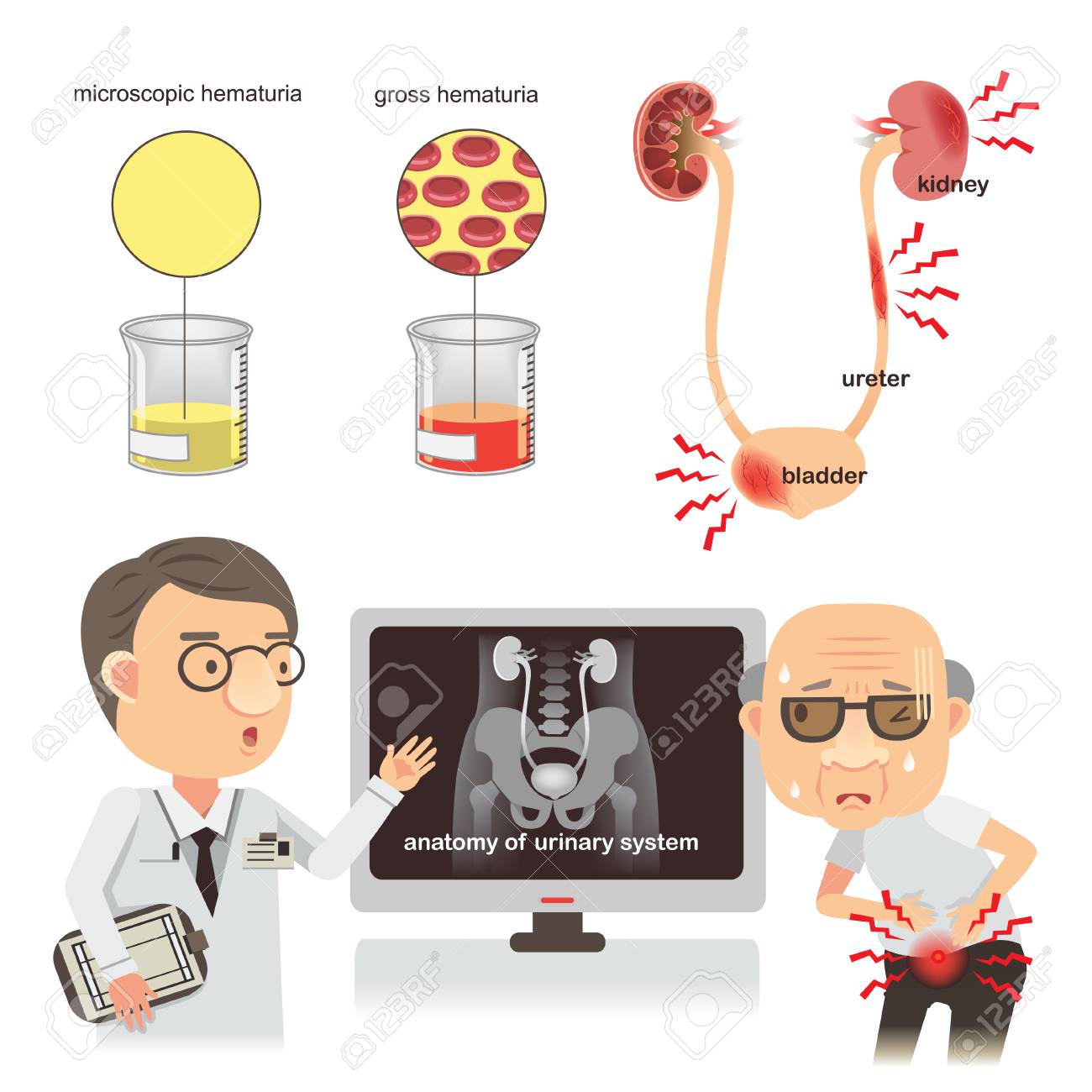 Doctors discussing a patient with abdominal pain.Normal urine and bloody urine Inflammation of the kidney, human urinary organs, kidney, bladder, isolated on white background. Vector illustrations - 91359375 Doctors discussing a patient with abdominal pain.Normal urine and bloody urine Inflammation of the kidney, human urinary organs, kidney, bladder, isolated on white background. Vector illustrations - 91359375