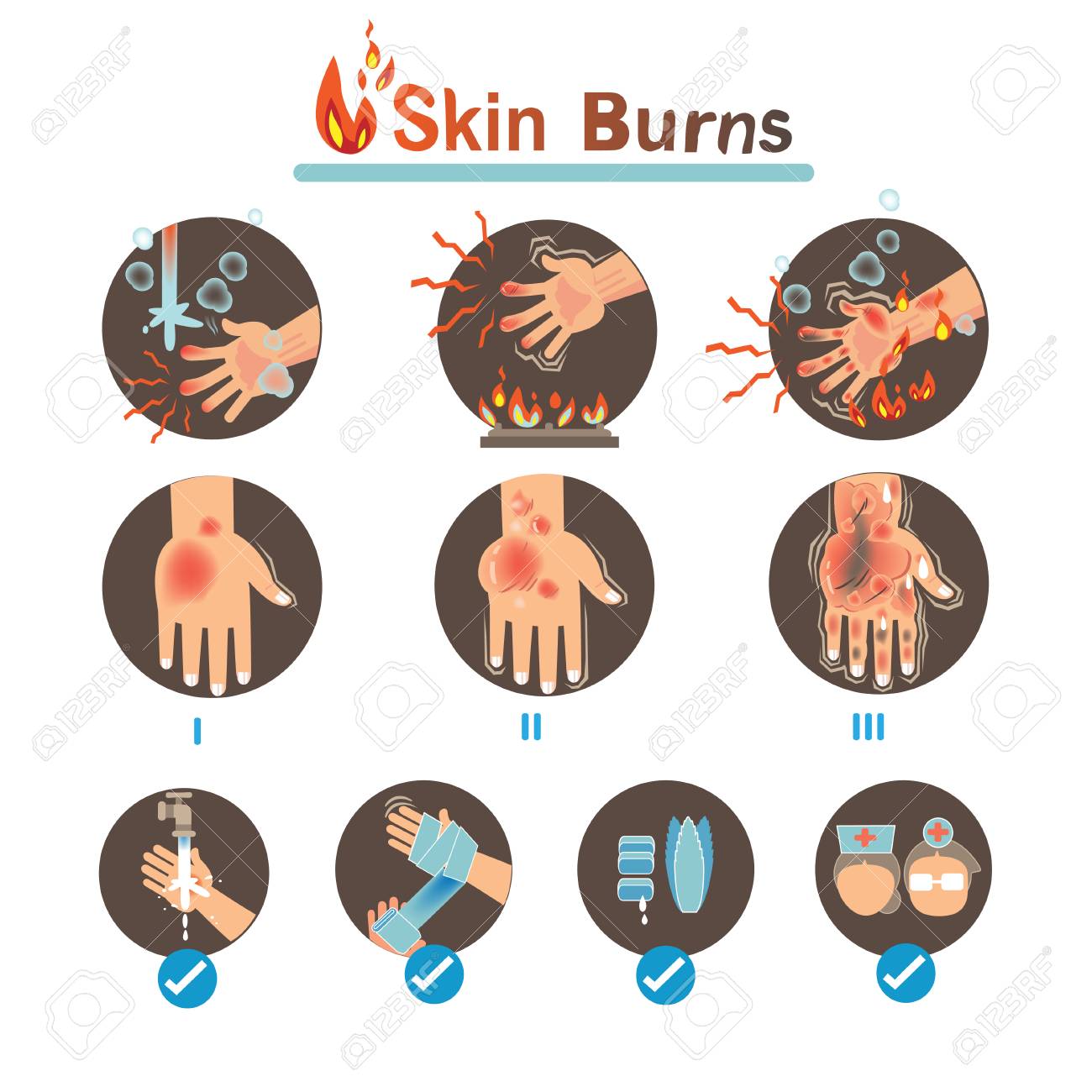 Skin burns Degree Burns and Thermal Burns Treatment,Vector illustrations - 91375855 Skin burns Degree Burns and Thermal Burns Treatment,Vector illustrations - 91375855