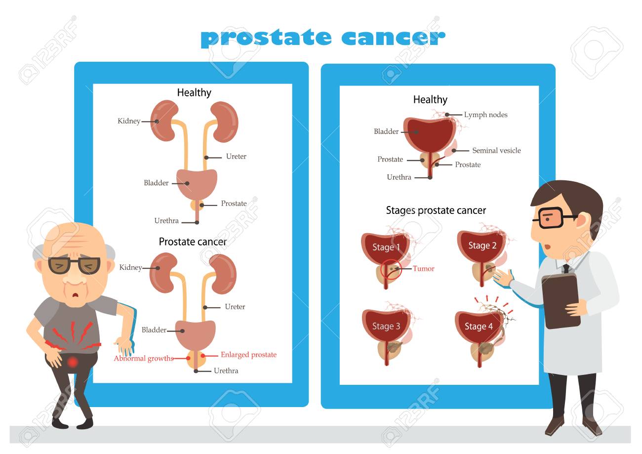 hombre de cáncer de próstata de