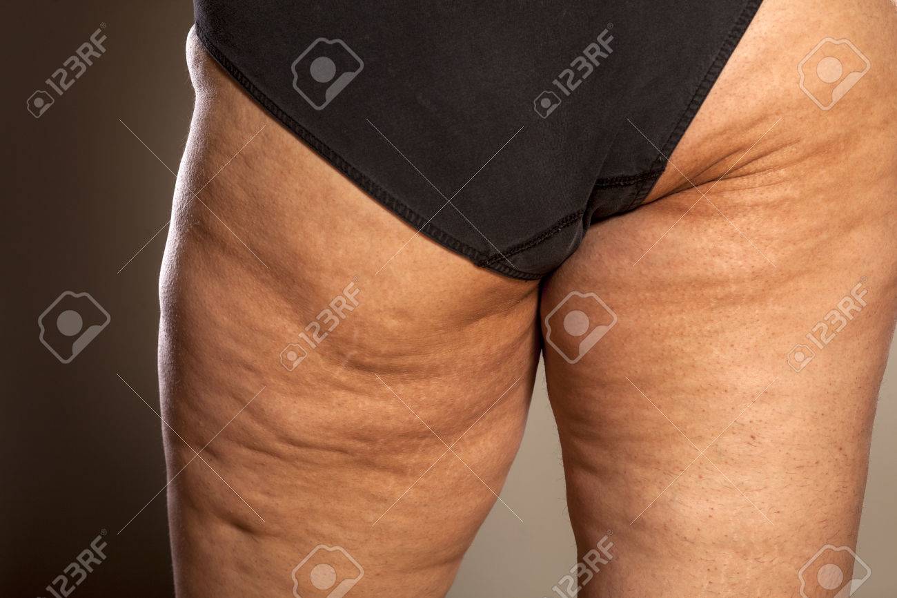 estrías y celulitis en inglés estrías y celulitis en inglés