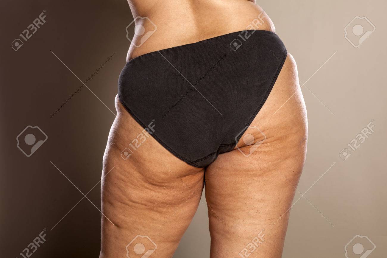 panty cellulite