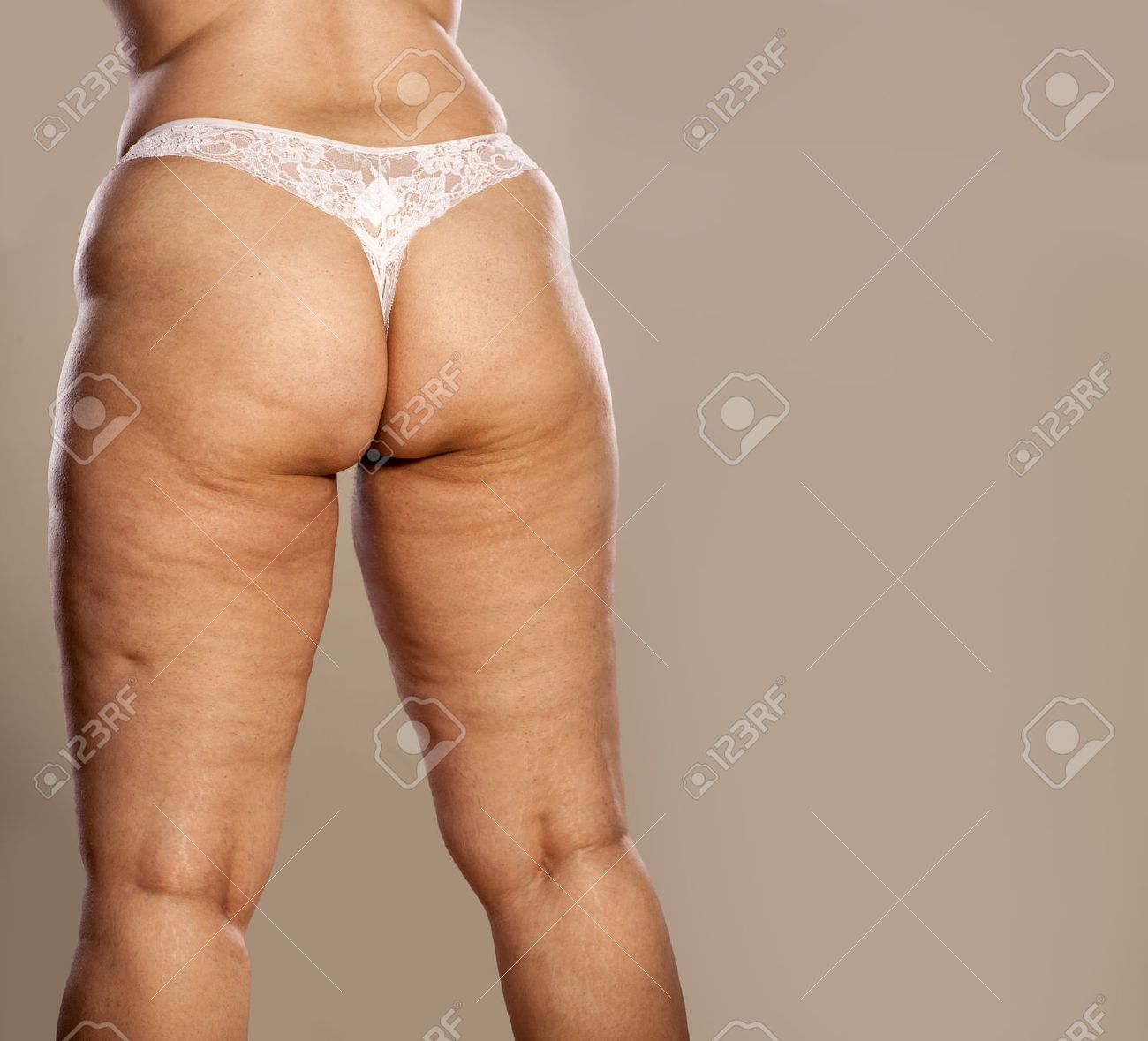 Fat Female Buttocks With Cellulite And Stretch Marks In White Thong Stock  Photo, Picture and Royalty Free Image. Image 65621885.