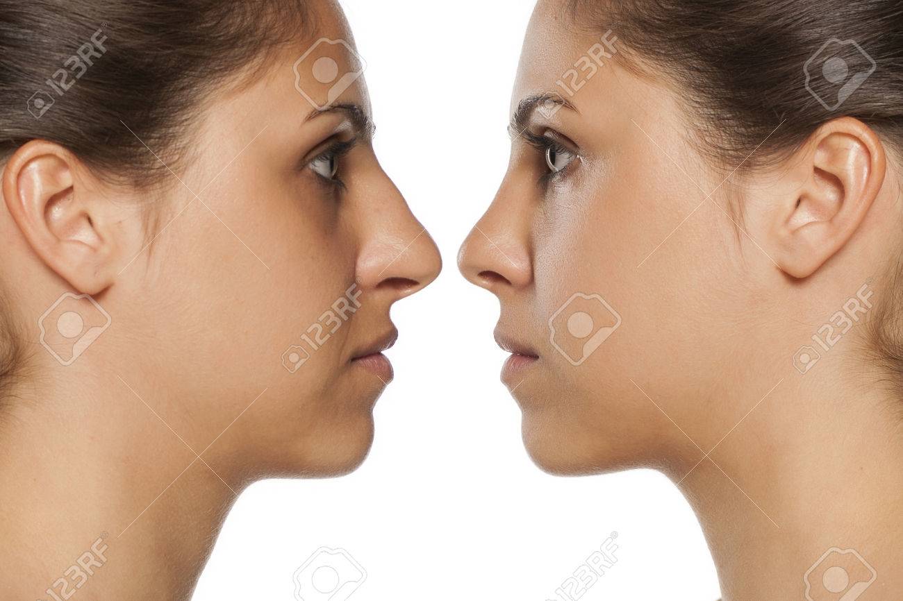 鼻の矯正前後の若い女性像の比較 の写真素材 画像素材 Image