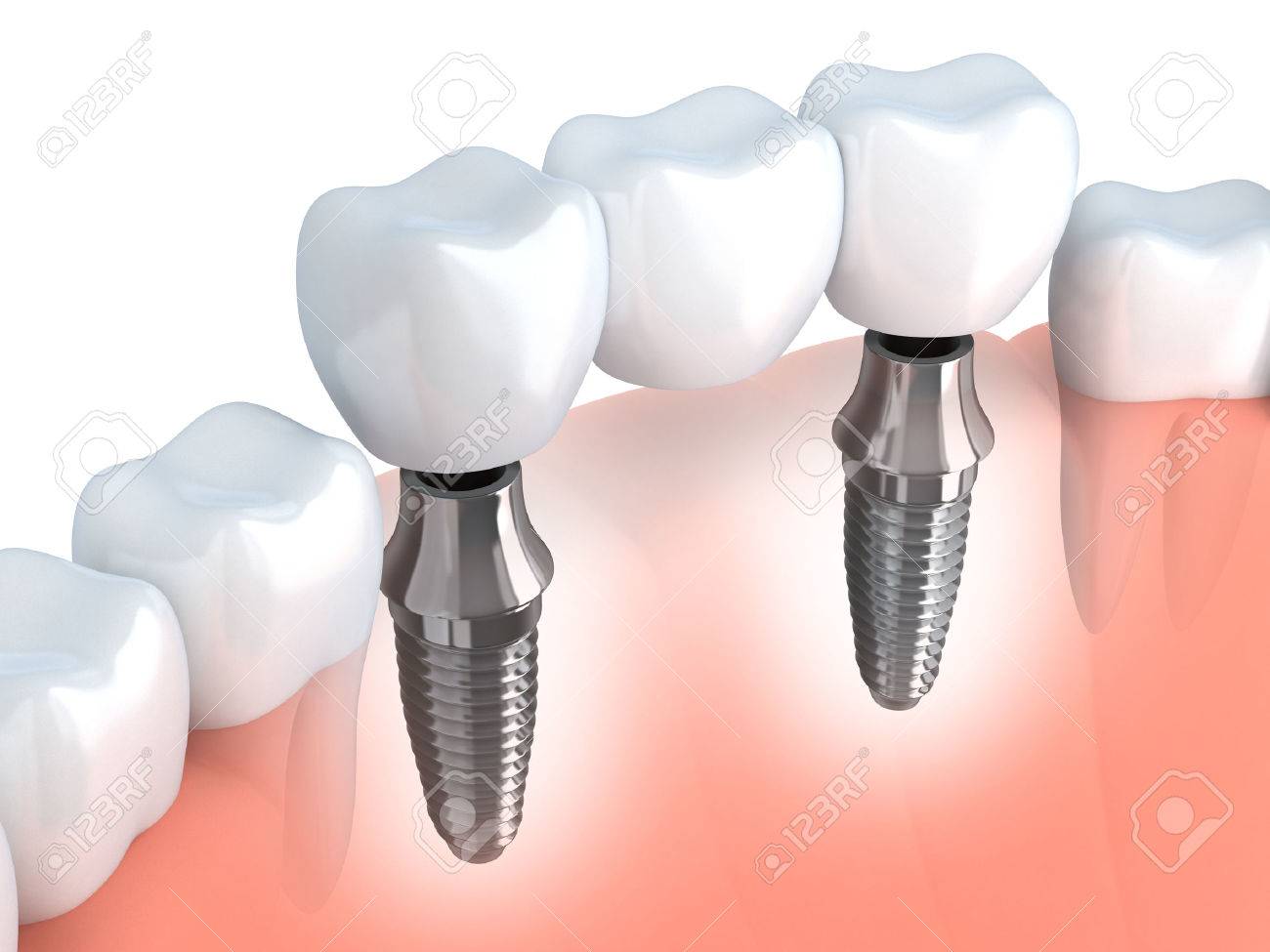 Tooth human implant (done in 3d graphics) - 37705776 Tooth human implant (done in 3d graphics) - 37705776