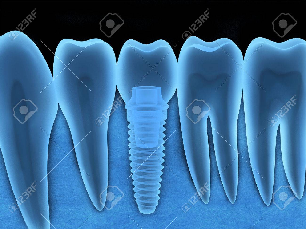 Tooth human implant x-ray (done in 3d, graphics) - 56240942 Tooth human implant x-ray (done in 3d, graphics) - 56240942