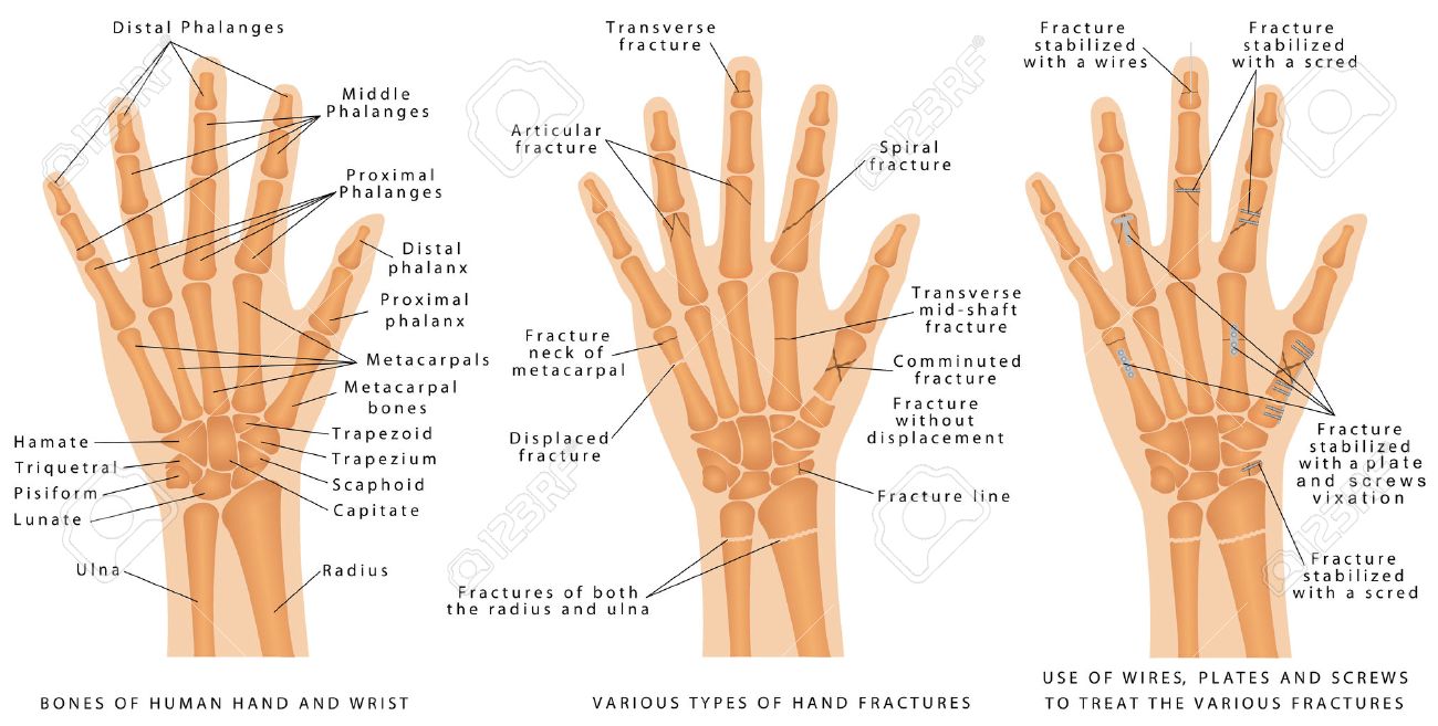Radius. Description. Some types of fractures Radius. Description. Some types of fractures
